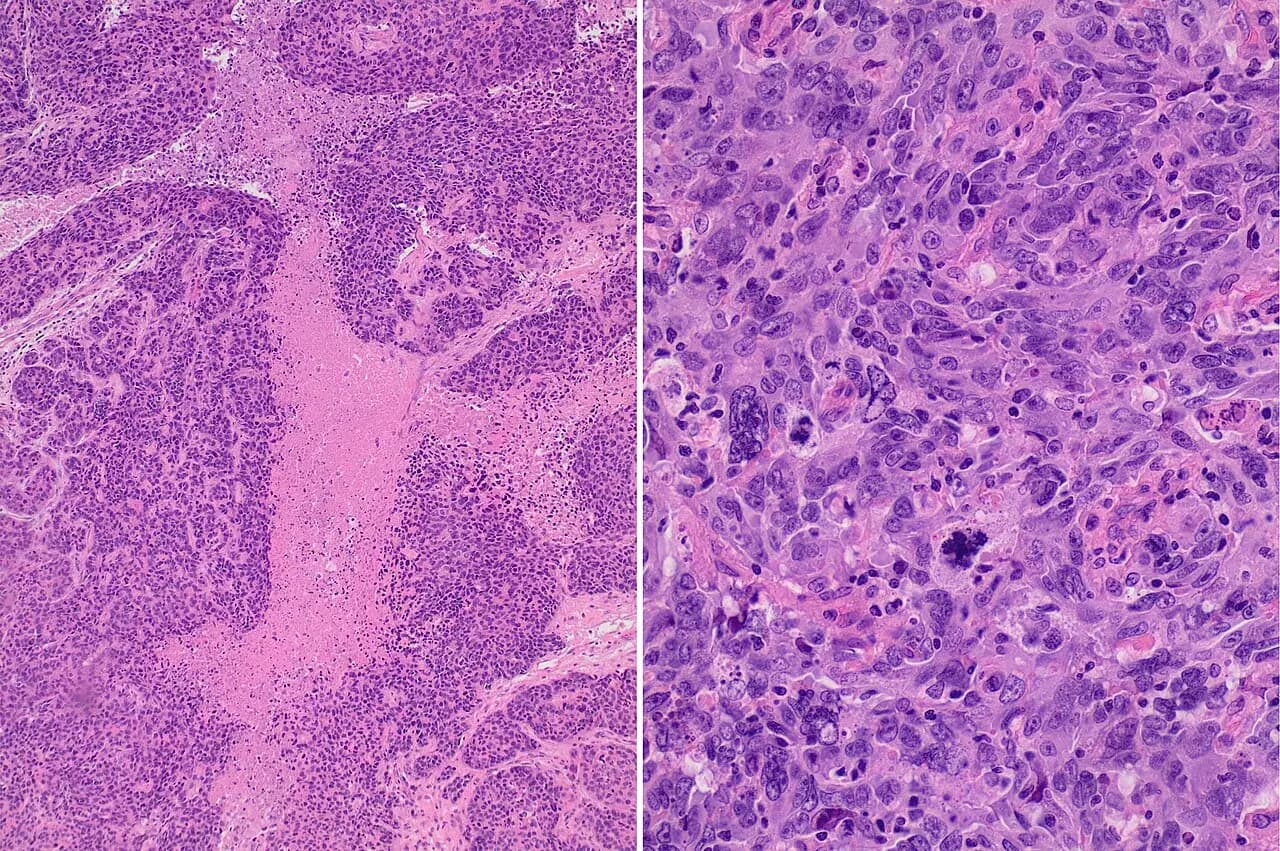 Histology of basal-like breast cancer tissue